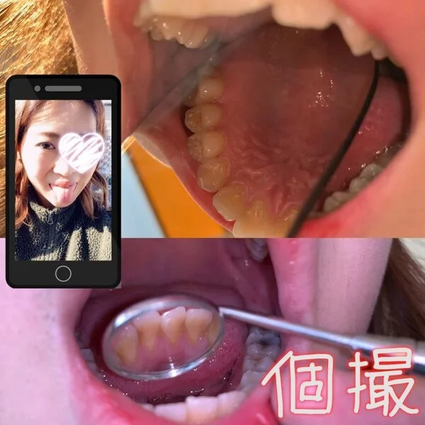 【虫歯・ヤニ注意】カズノコ天井!(※注)巨根女(喉ちんこ)の口内をミラーで余すと