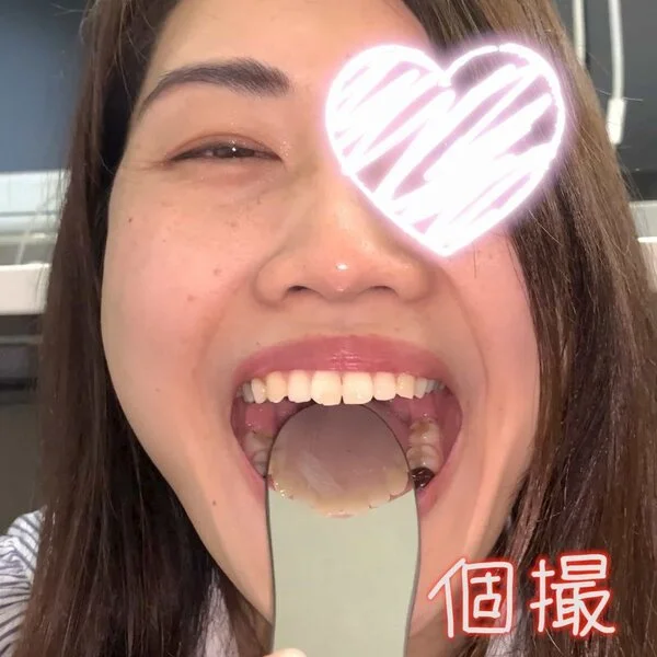 【個人撮影】※かぶせ銀歯&虫歯※ デンタルミラーで派遣事務員の口内をチェックした