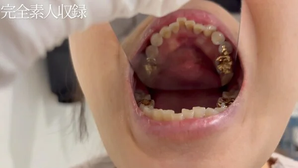 【素人・口腔フェチ】これが見れるのは奇跡です。金歯の20歳を余すとこなく完全収録