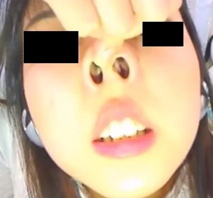 プレミア★ノーズXX アナと鼻の女王